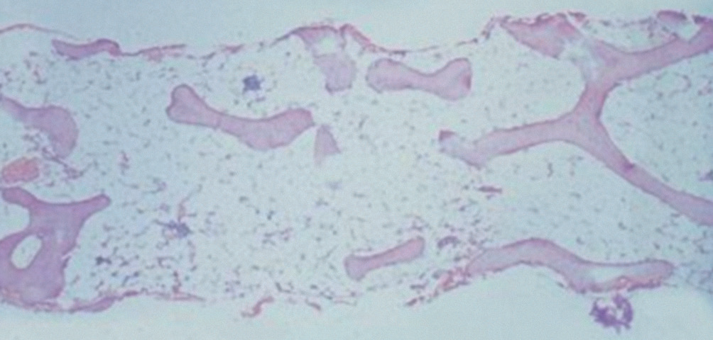 Biopsia-dellaplasia-midollare