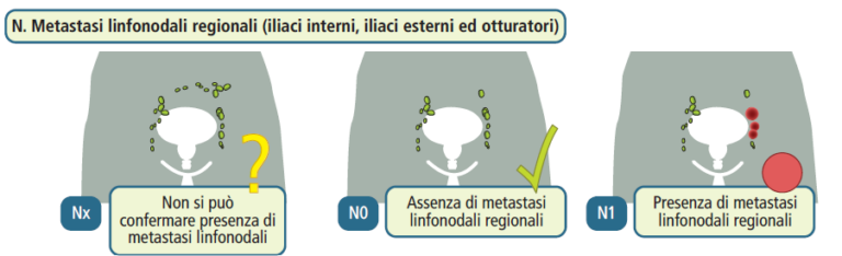 Il carcinoma prostatico locale, avanzato e metastatico: stadiazione ...