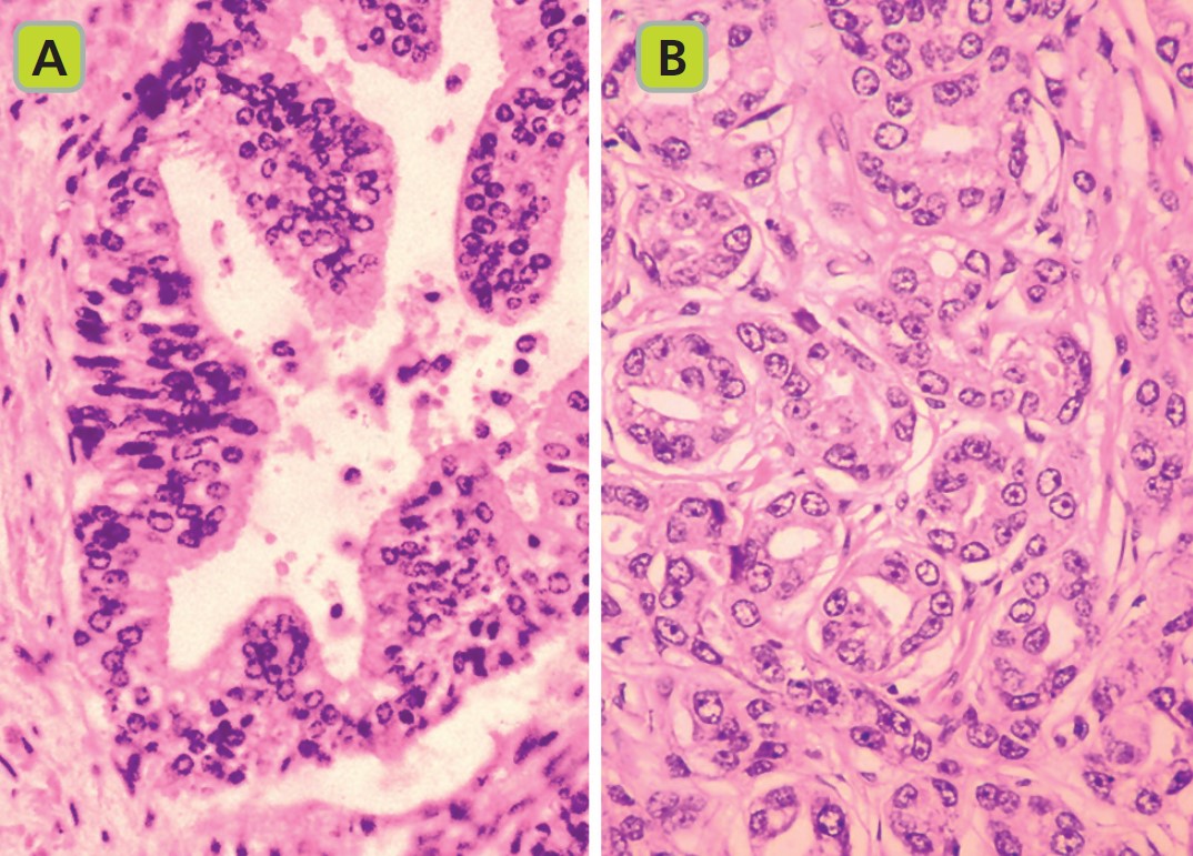 Il carcinoma prostatico locale, avanzato e metastatico: stadiazione ...