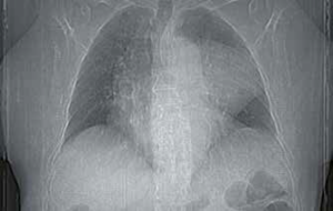 Le patologie mediastiniche in radiologia – Bald Mountain Science