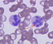 le-anemie-megaloblastiche-megaloblastosi