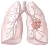 neoplasie-maligne-polmonari