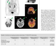 ruolo-della-pet-ct-con-fdg-nella-diagnosi-e-gestione-dei-linfomi-e-del-mieloma-multiplo-immagini