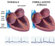 fibrillazione