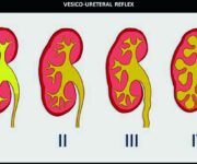 Gradi di reflusso vescico-ureterale usato negli studi con radionucleotidi