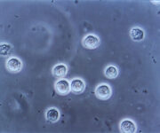 Batteriuria asintomatica: quando l’antibiotico non serve batteriuria