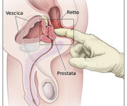 prostatico