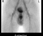 Scintigrafia testicolare con Tc-99m pertecnetato Imagin scrotale normale ottenuto usando Tc-99m pertecnetato