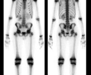 La Medicina Nucleare per lo studio dell'apparato Muscolo-Scheletrico Normale scintigrafia ossea