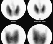 differenza pinhole normale