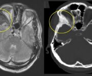 Displasia fibrosa: clinica, diagnosi e trattamento Displasia fibrosa dell’osso zigomatico di destra alla MRI in T2 e TC