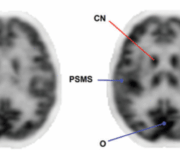 PET Cerebrale con FDG per la diagnosi di demenza e pattern cerebrali image